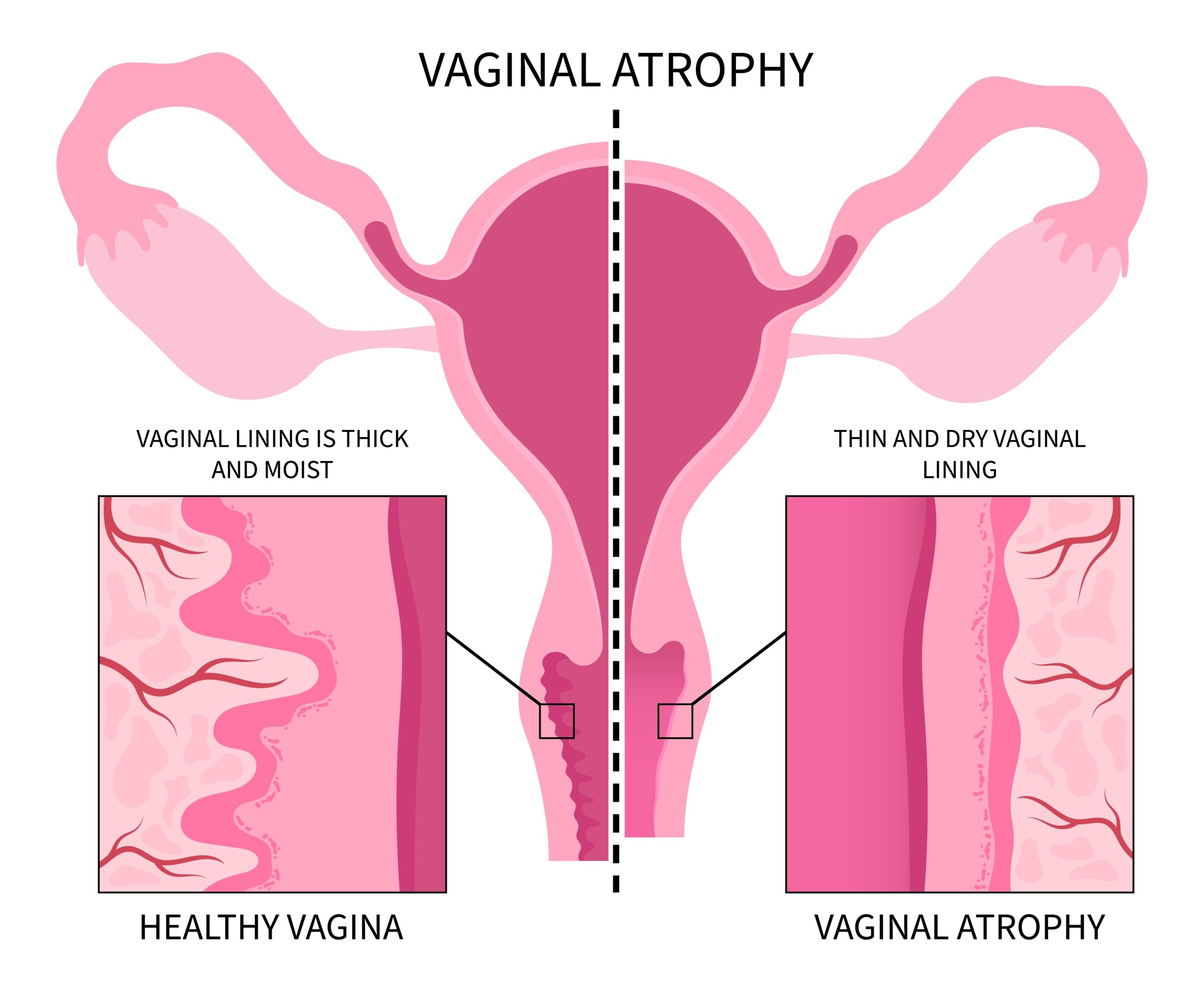 Vaginal,Atrophy,Level,Cervix,Drying,Pain,Tract,Or,Uti,Canal