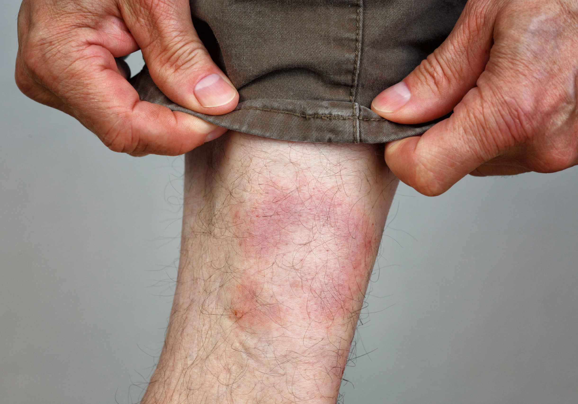 Symptom of Lyme Disease, Circular Expanding Rash, Erythema Migra